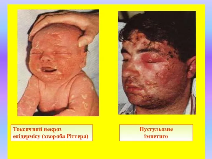 Токсичний некроз епідермісу (хвороба Ріттера) Пустульозне імпетиго