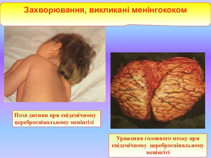 Поза дитини при епідемічному цереброспінальному менінгіті Ураження головного мозку при епідемічному цереброспінальному менінгіті Захворювання, викликані менінгококом