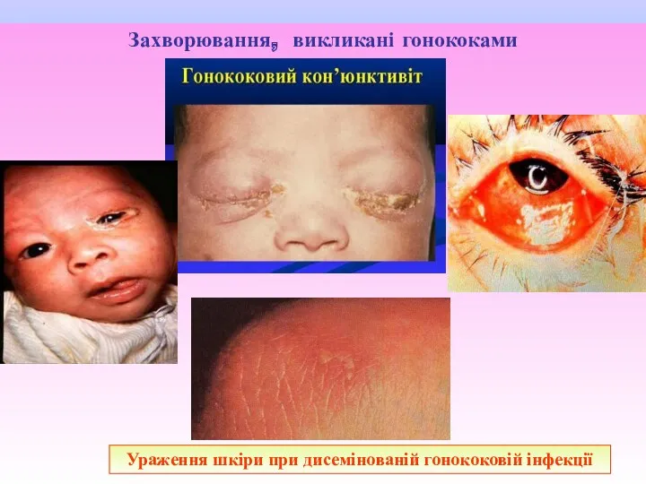 Захворювання, викликані гонококами Ураження шкіри при дисемінованій гонококовій інфекції Гонококовий кон’юктивіт