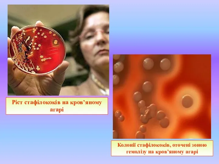 Колонії стафілококів, оточені зоною гемолізу на кров’яному агарі Ріст стафілококів на кров’яному агарі