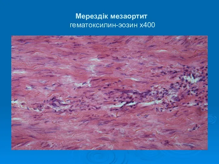 Мерездік мезаортит гематоксилин-эозин х400