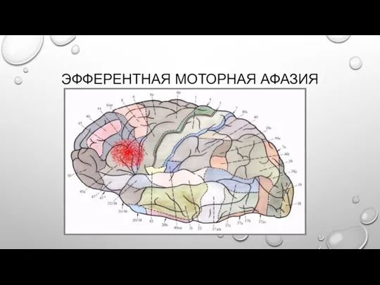 ЭФФЕРЕНТНАЯ МОТОРНАЯ АФАЗИЯ