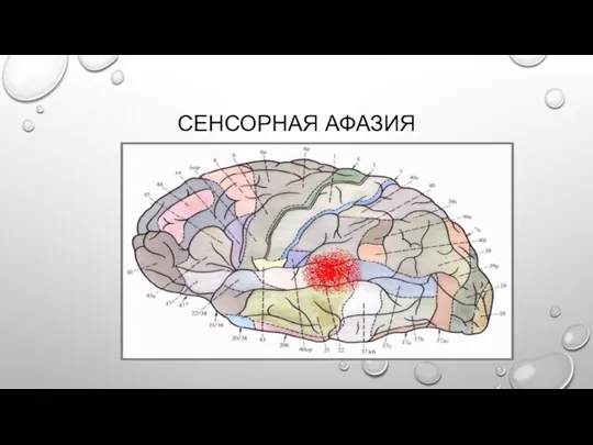 СЕНСОРНАЯ АФАЗИЯ