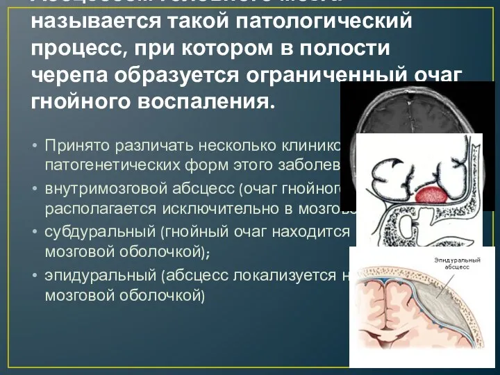 Абсцессом головного мозга называется такой патологический процесс, при котором в