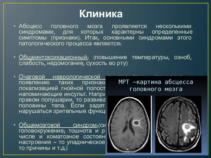 Клиника Абсцесс головного мозга проявляется несколькими синдромами, для которых характерны