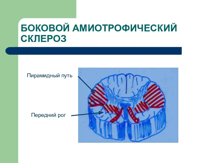 БОКОВОЙ АМИОТРОФИЧЕСКИЙ СКЛЕРОЗ Пирамидный путь Передний рог