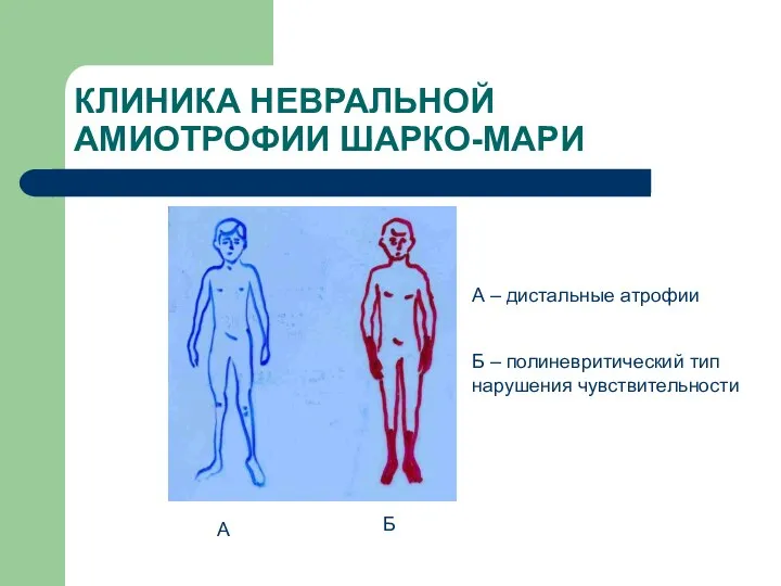 КЛИНИКА НЕВРАЛЬНОЙ АМИОТРОФИИ ШАРКО-МАРИ А Б А – дистальные атрофии Б – полиневритический тип нарушения чувствительности