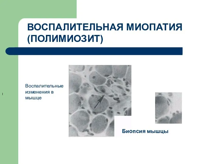 ВОСПАЛИТЕЛЬНАЯ МИОПАТИЯ (ПОЛИМИОЗИТ) I Биопсия мышцы Воспалительные изменения в мышце