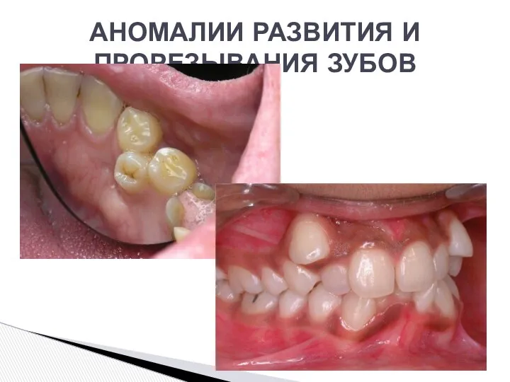 АНОМАЛИИ РАЗВИТИЯ И ПРОРЕЗЫВАНИЯ ЗУБОВ