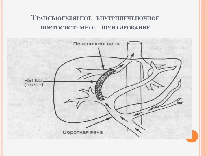 Трансъюгулярное внутрипеченочное портосистемное шунтирование