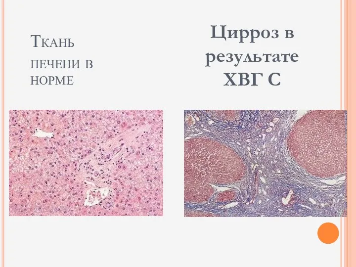 Ткань печени в норме Цирроз в результате ХВГ С