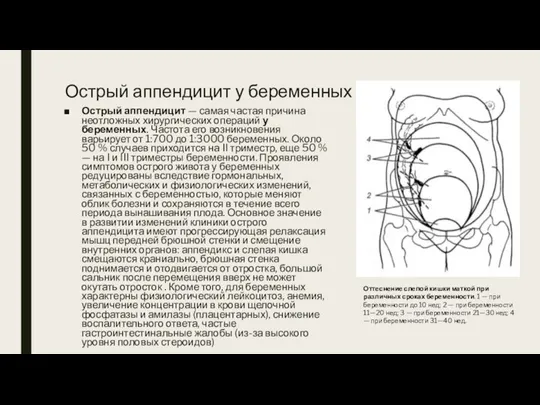 Острый аппендицит у беременных Острый аппендицит — самая частая причина