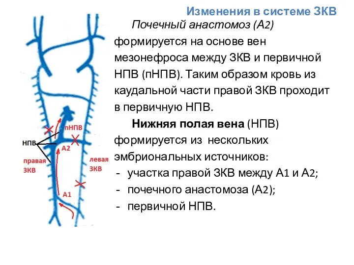 Изменения в системе ЗКВ Почечный анастомоз (А2) формируется на основе