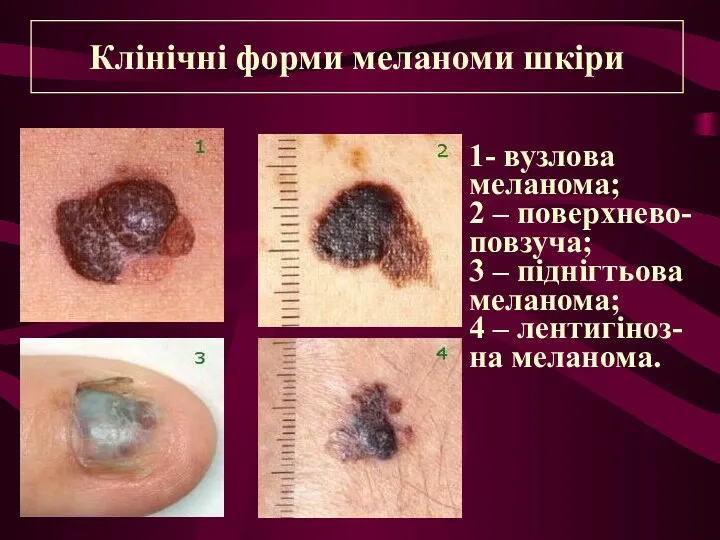 Клінічні форми меланоми шкіри 1- вузлова меланома; 2 – поверхнево-
