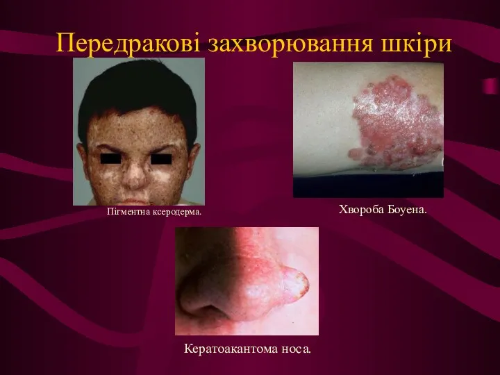 Передракові захворювання шкіри Пігментна ксеродерма. Хвороба Боуена. Кератоакантома носа.