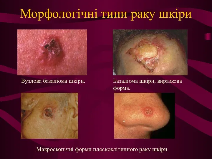 Морфологічні типи раку шкіри Вузлова базаліома шкіри. Базаліома шкіри, виразкова форма. Макроскопічні форми плоскоклітинного раку шкіри