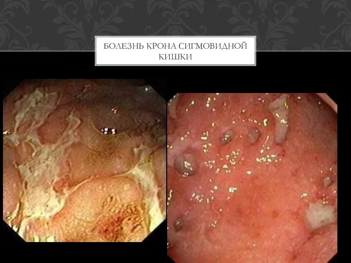 БОЛЕЗНЬ КРОНА СИГМОВИДНОЙ КИШКИ