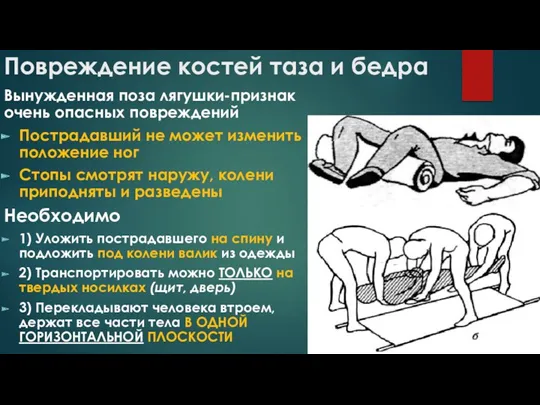 Повреждение костей таза и бедра Вынужденная поза лягушки-признак очень опасных