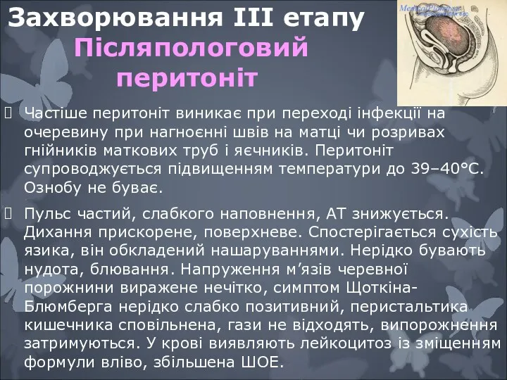 Захворювання IIІ етапу Пiсляпологовий перитонiт Частiше перитонiт виникає при переходi