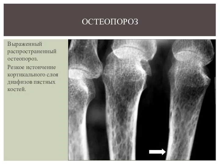 Выраженный распространенный остеопороз. Резкое истончение кортикального слоя диафизов пястных костей. ОСТЕОПОРОЗ