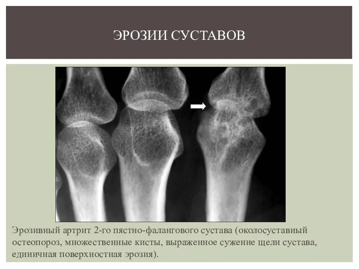 Эрозивный артрит 2-го пястно-фалангового сустава (околосуставный остеопороз, множественные кисты, выраженное сужение щели сустава,