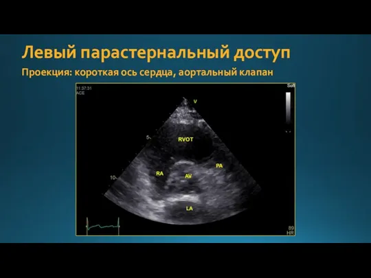 Левый парастернальный доступ Проекция: короткая ось сердца, аортальный клапан