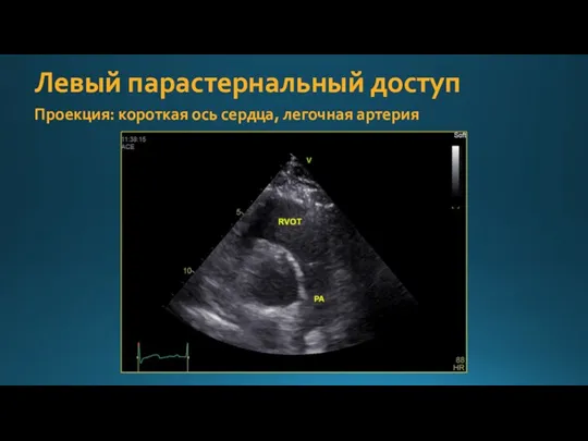 Левый парастернальный доступ Проекция: короткая ось сердца, легочная артерия