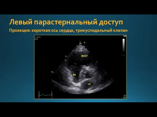 Левый парастернальный доступ Проекция: короткая ось сердца, трикуспидальный клапан