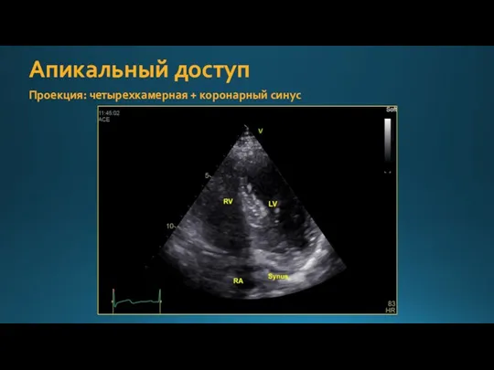 Апикальный доступ Проекция: четырехкамерная + коронарный синус