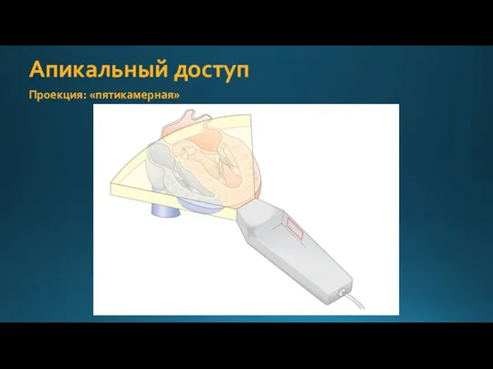 Апикальный доступ Проекция: «пятикамерная»