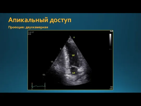 Апикальный доступ Проекция: двухкамерная