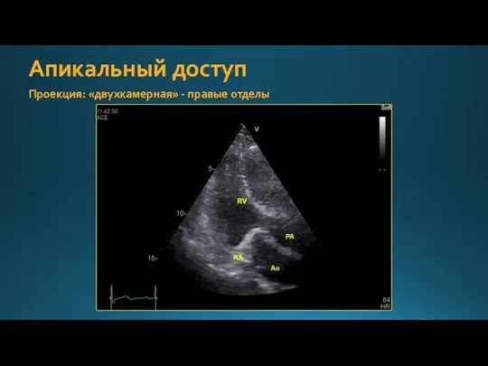 Апикальный доступ Проекция: «двухкамерная» - правые отделы