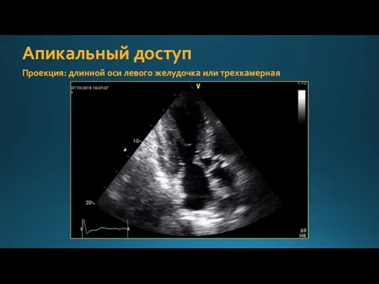 Апикальный доступ Проекция: длинной оси левого желудочка или трехкамерная