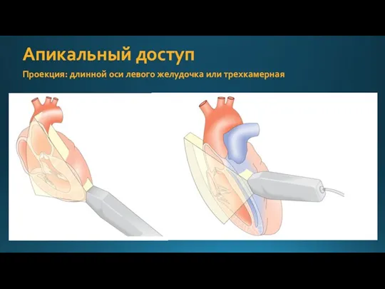 Апикальный доступ Проекция: длинной оси левого желудочка или трехкамерная