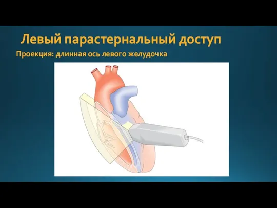 Левый парастернальный доступ Проекция: длинная ось левого желудочка