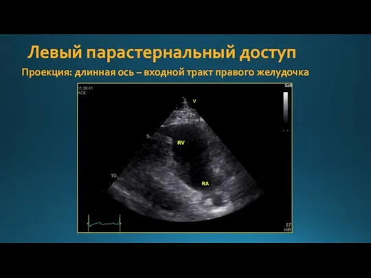 Левый парастернальный доступ Проекция: длинная ось – входной тракт правого желудочка