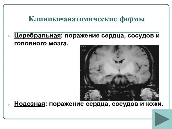 Клинико-анатомические формы Церебральная: поражение сердца, сосудов и головного мозга. Нодозная: поражение сердца, сосудов и кожи.