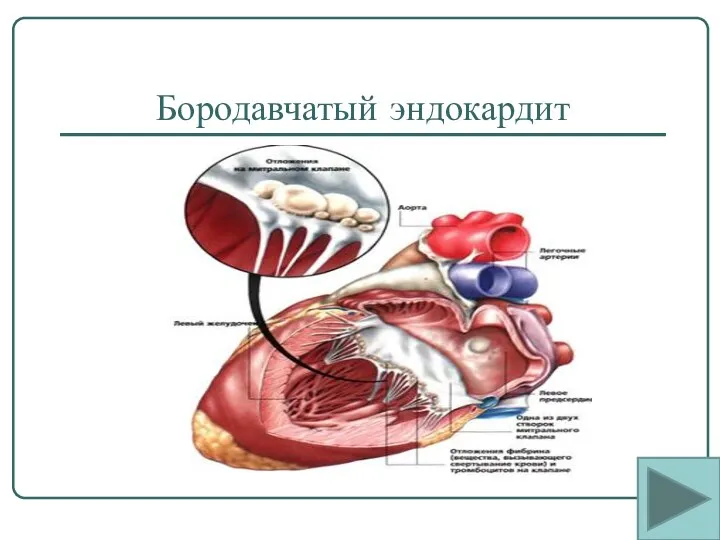 Бородавчатый эндокардит