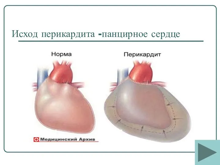 Исход перикардита -панцирное сердце