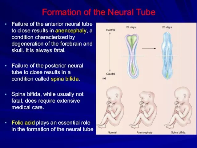 Formation of the Neural Tube Failure of the anterior neural tube to close
