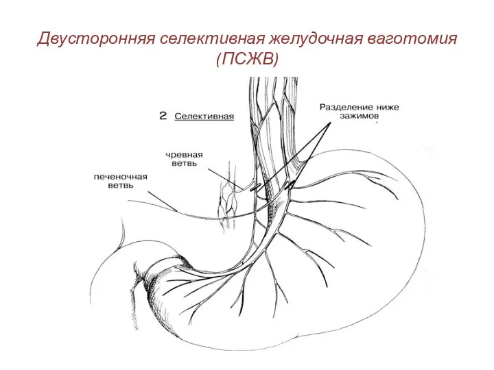 Двусторонняя селективная желудочная ваготомия (ПСЖВ)