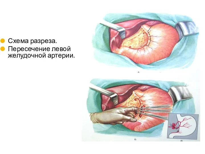 Схема разреза. Пересечение левой желудочной артерии.