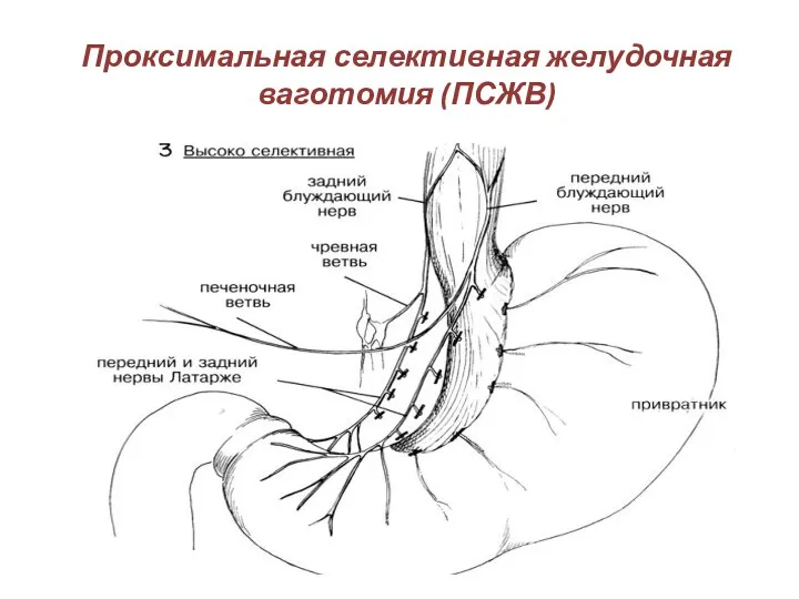 Проксимальная селективная желудочная ваготомия (ПСЖВ)