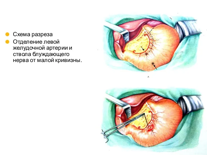 Схема разреза Отделение левой желудочной артерии и ствола блуждающего нерва от малой кривизны.