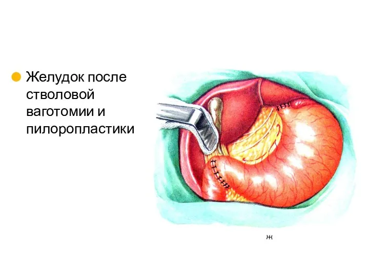 Желудок после стволовой ваготомии и пилоропластики