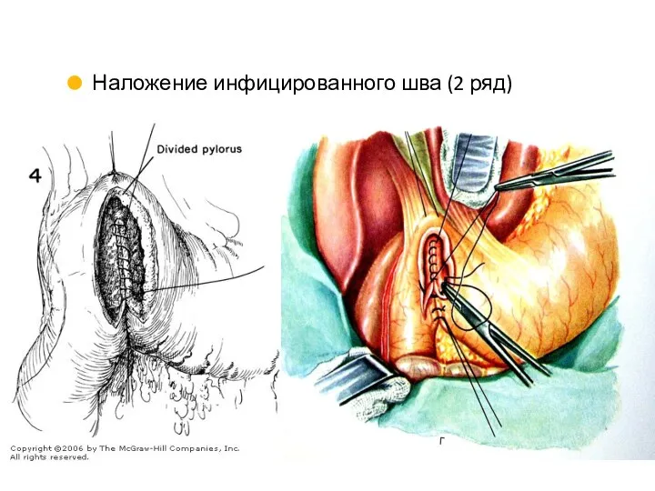 Наложение инфицированного шва (2 ряд)