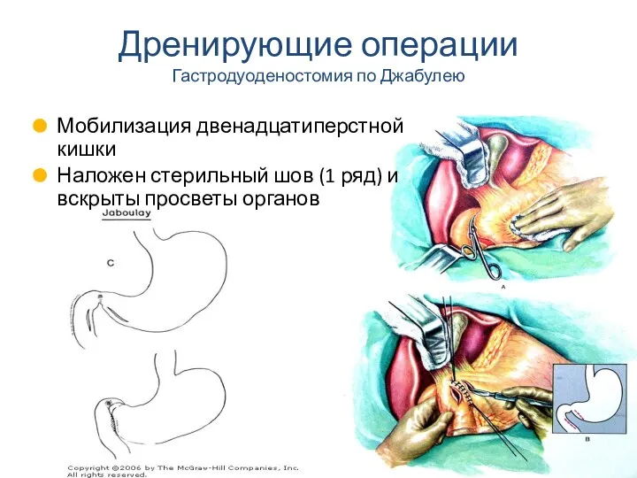 Мобилизация двенадцатиперстной кишки Наложен стерильный шов (1 ряд) и вскрыты