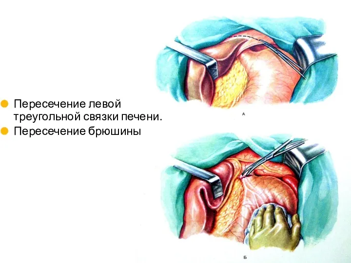 Пересечение левой треугольной связки печени. Пересечение брюшины