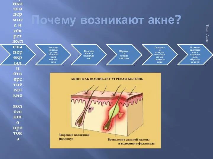 Почему возникают акне? Тема: Акне Ороговевшие чешуйки эпидермиса и секрет