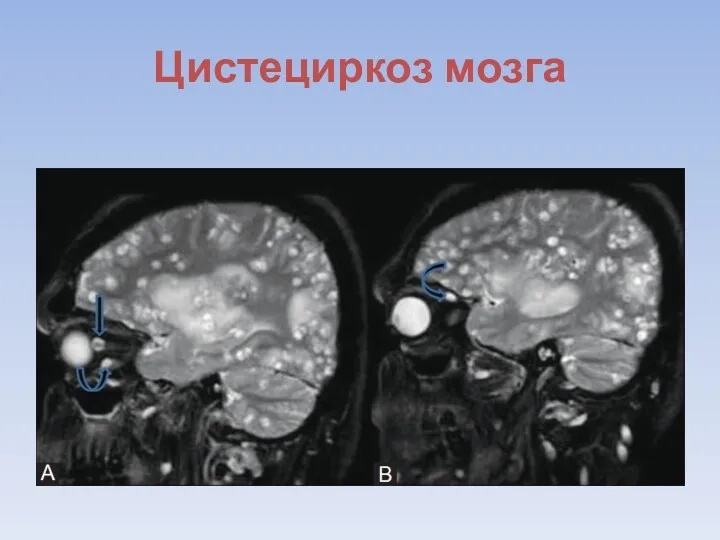 Цистециркоз мозга